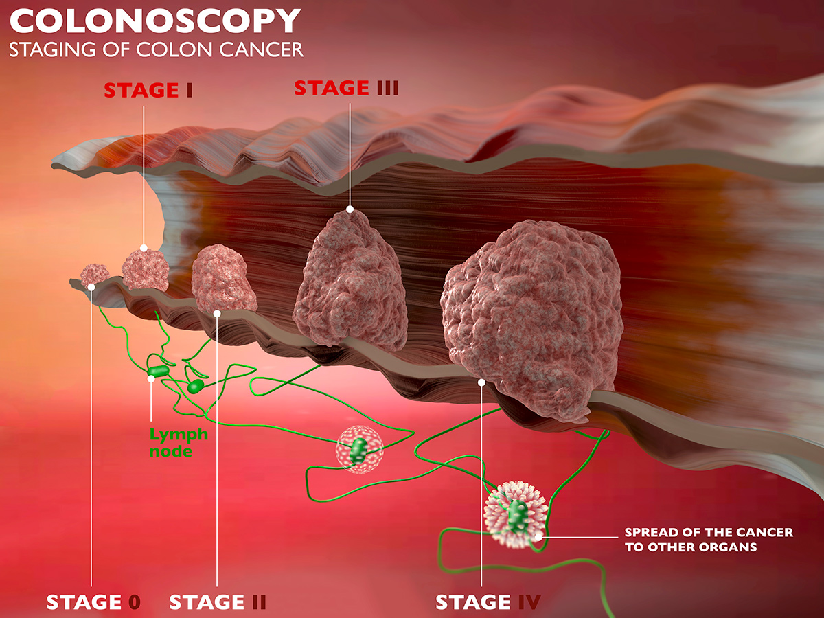 Colorectal Cancer